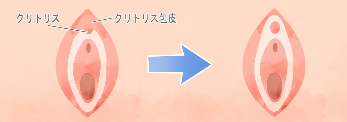 年齢別】10代20代の包茎の正しい剥き方はこれ！ - アトムクリニック -