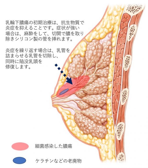 乳輪縮小術について｜バスト医療のナグモクリニック