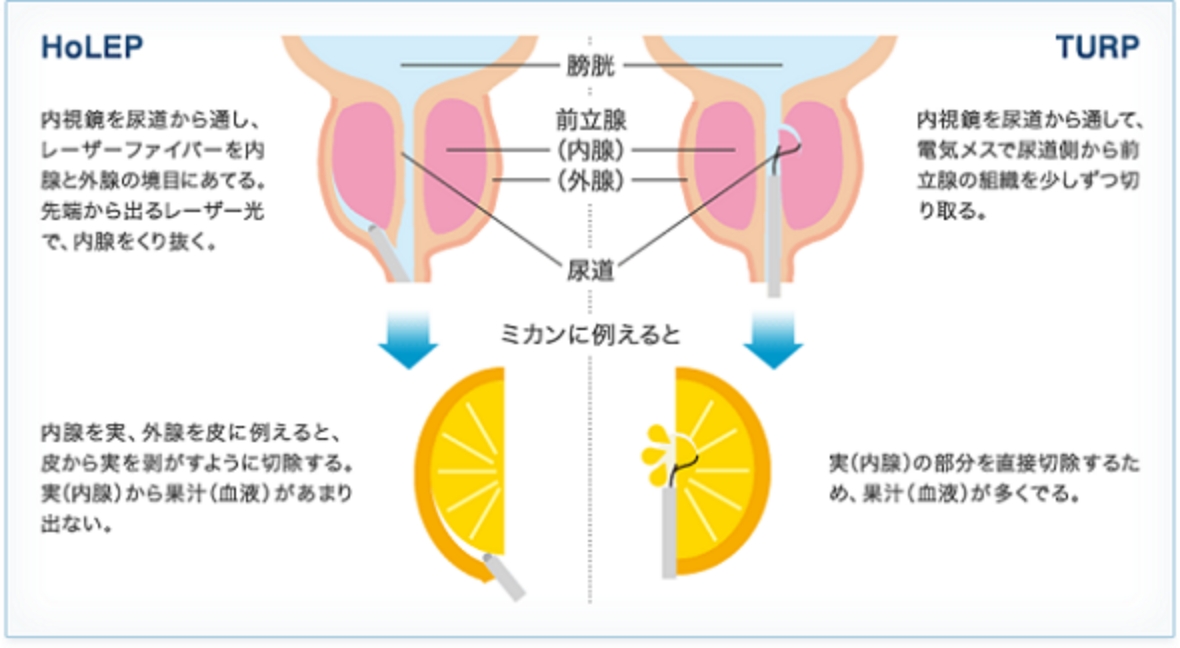 尿がでにくい・尿の勢いが弱い（排尿困難） | みうら泌尿器科クリニック