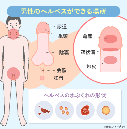 性器ヘルペス感染症の原因と症状 - 治し方と治療薬について|天神マイケアクリニック