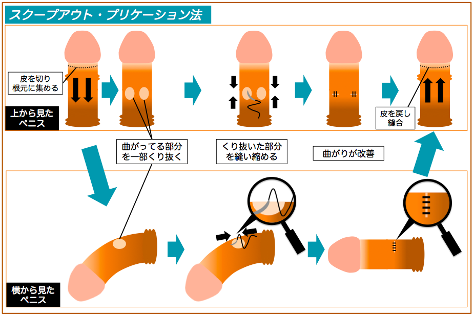 子どもの包茎｜要町駅より徒歩1分の泌尿器科｜豊島区の要町駅前クリニック