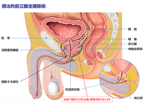 導尿の仕方(男性の場合)｜自己導尿情報サイト｜患者様・一般の皆様｜ クリエートメディック株式会社