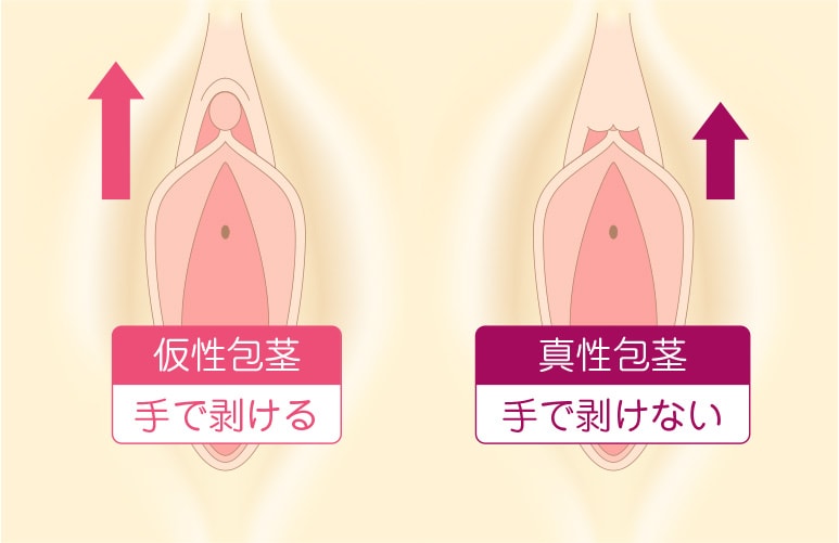 包茎矯正下着「ビガーパンツ」は効果ある？仕組みについても詳しく解説 –メンズクリニック研究会-包茎