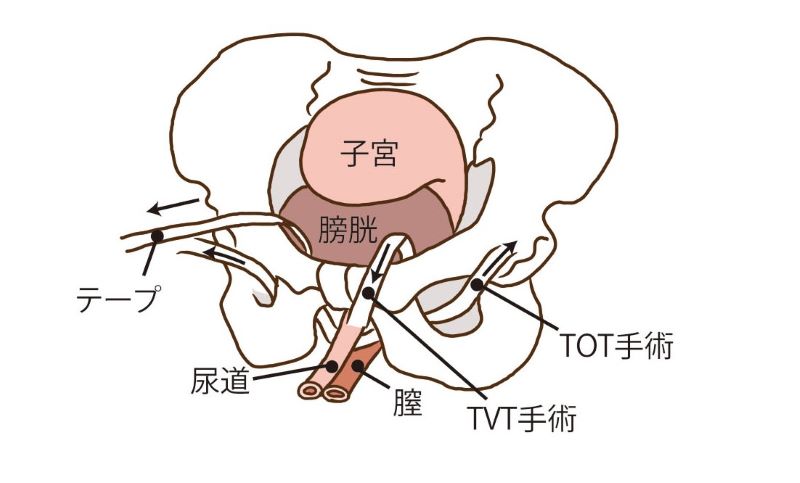 骨盤臓器脱 - 子宮脱治療、膀胱脱治療や直腸脱治療について専門医が説明します|Ｕｒｏｇｙｎｅネット