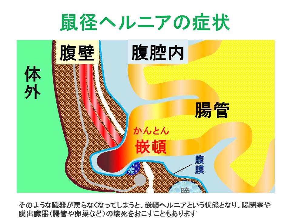 脱腸 鼠径部 儚