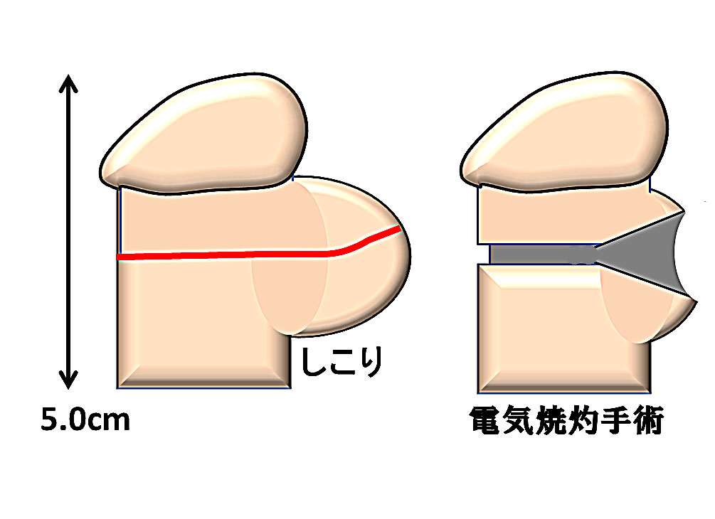 泌尿器科の専門医が解説】包茎手術のペリカン変形に関する原因・予防・修正方法