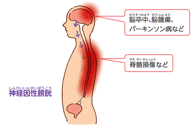 お風呂上がりの膣から湯漏れ」と「くしゃみで尿漏れ」の原因は？改善する骨盤底筋エクササイズとは？