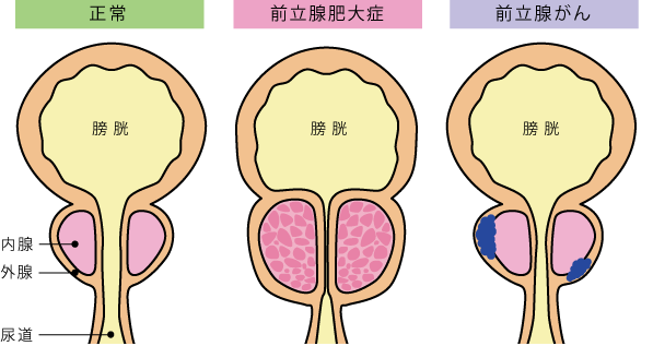 ガイドラインに基づいた前立腺肥大症の正しい知識と治し方 | 同友会メディカルニュース