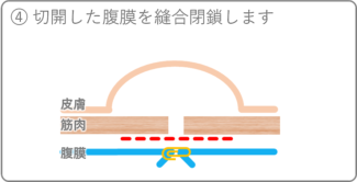 鼠径（そけい）ヘルニア外来 | 医療法人社団