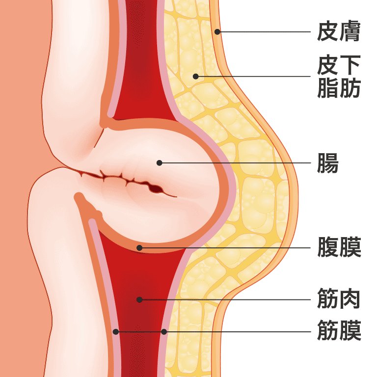 そけいヘルニア｜久留米市のひろつおなかクリニック