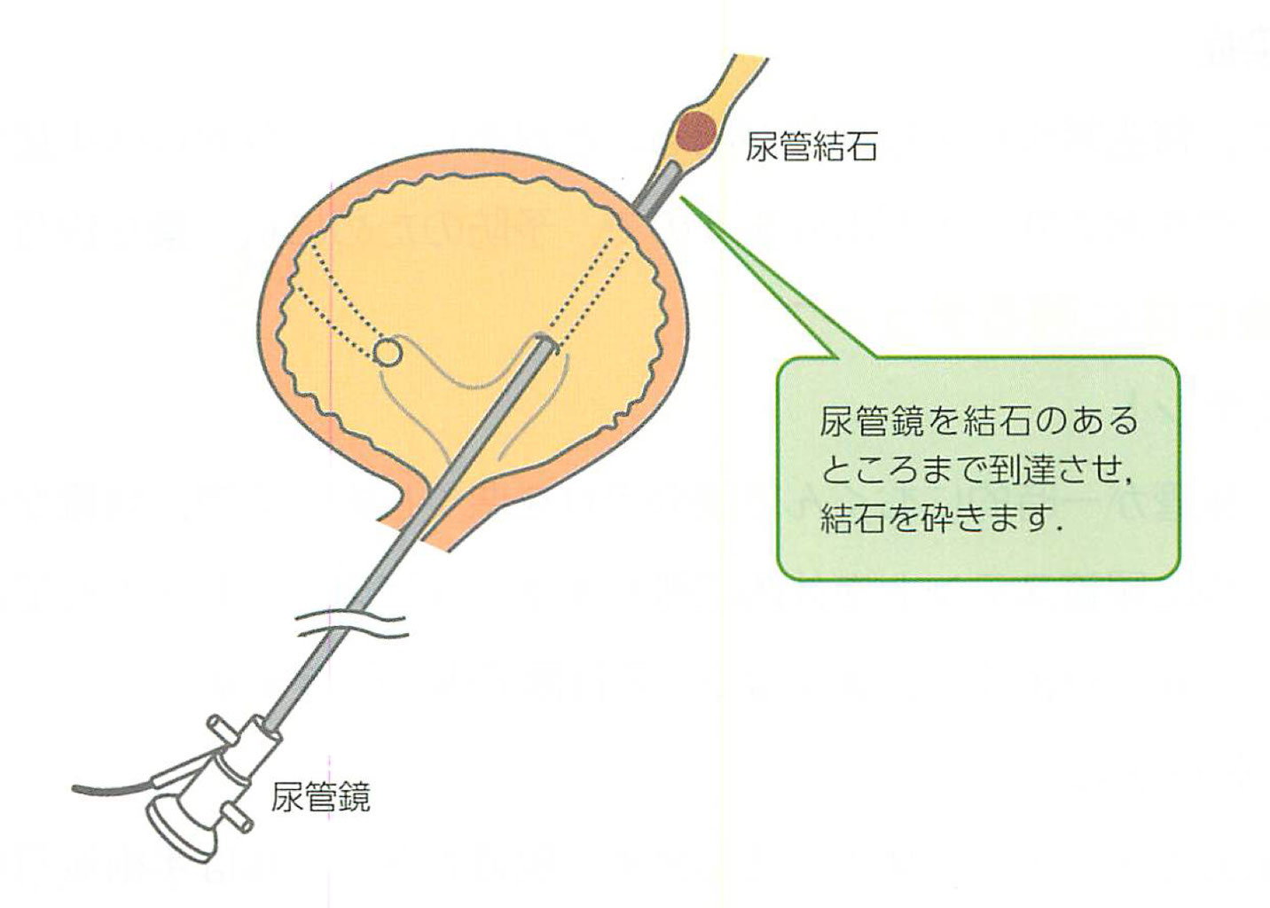 治療はつらいよ？…前立腺がん医療の「舞台裏」 : 読売新聞