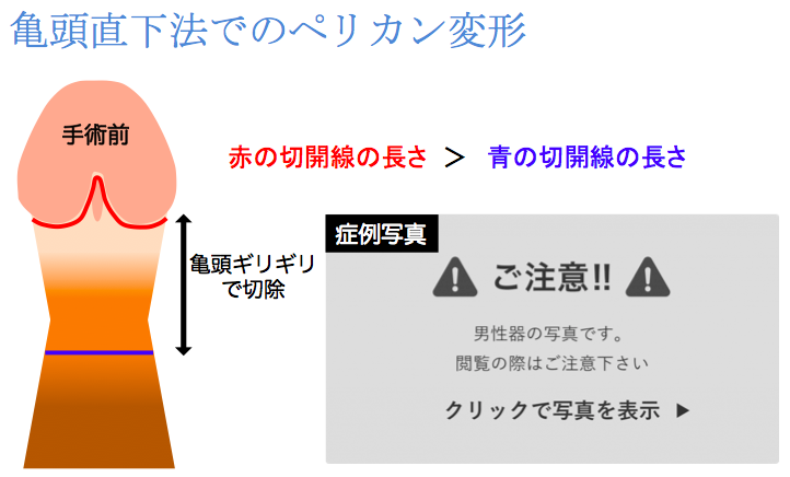 仮性包茎治療 | 鹿児島・福岡・東京 男性治療専門外来 セイコメディカルビューティクリニック