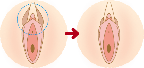 女性器形成（婦人科形成） - 渋谷の美容外科・美容整形クリニック