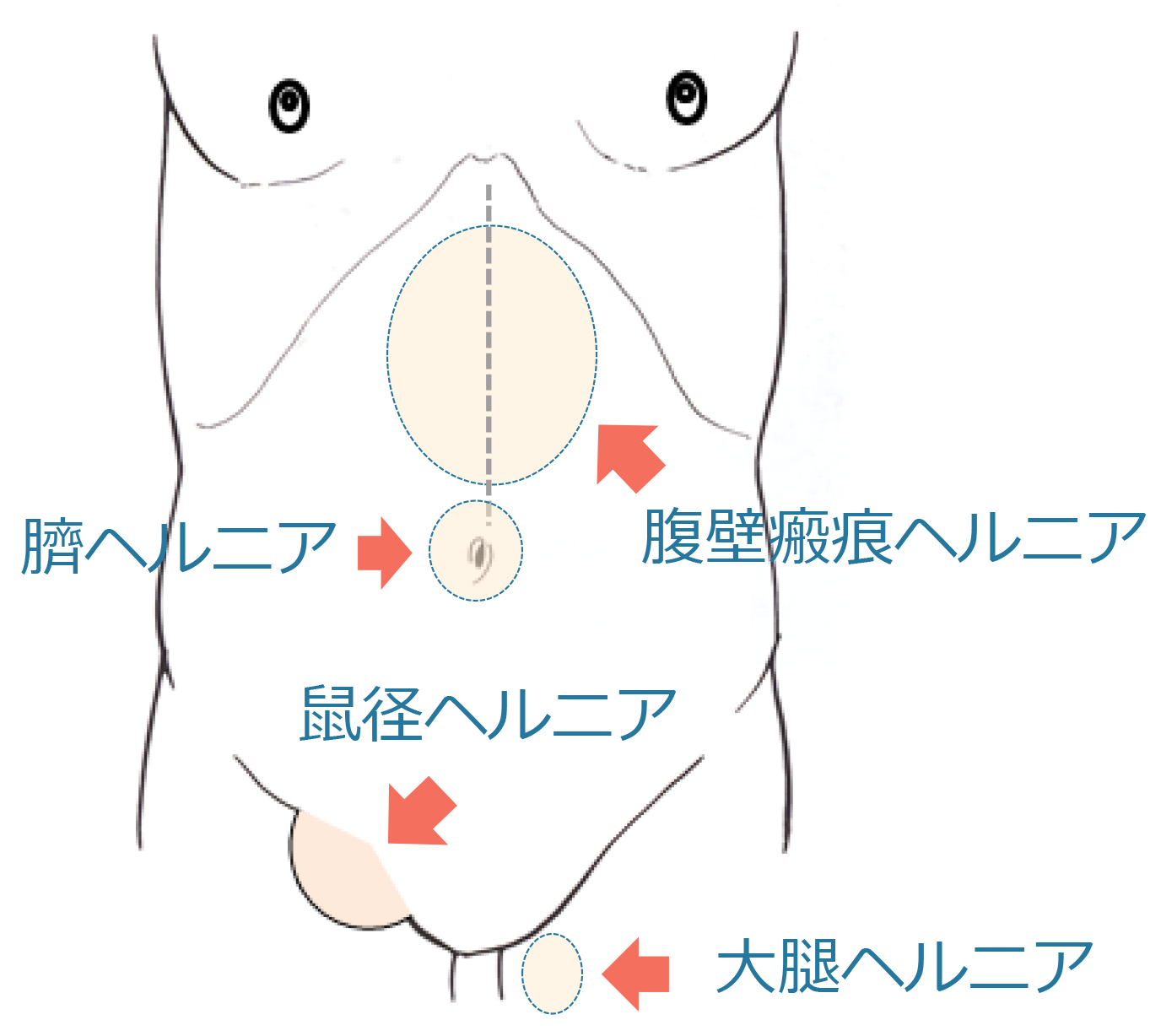 3ページ目｜アロマトリートメント 鼠径部に関するサロン リンパマッサージ＆腸もみ専門店 LOVit