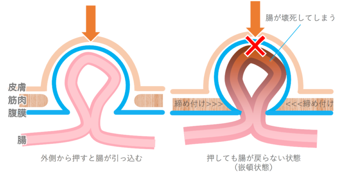 股関節を動かすと、鼠径部が鋭く痛む症状を改善する「マッサージポイント」｜安部元隆