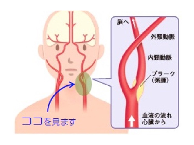 頸動脈狭窄｜KOMPAS