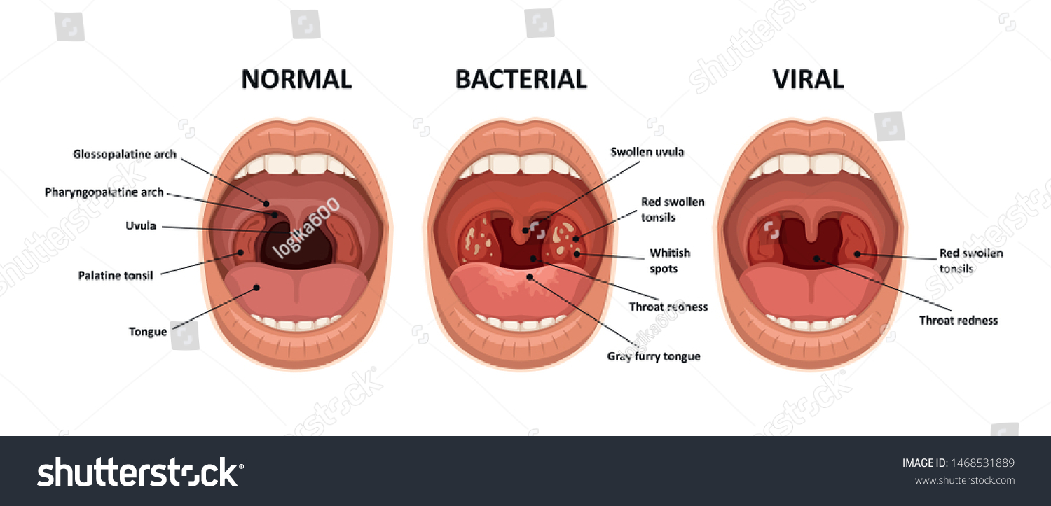 喉の細菌およびウイルス感染 扁桃腺炎症のベクトル イラスト ストックベクター