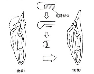 クリトリス包茎切除術 | KAZUKIプライベートクリニック【公式】｜美容外科・形成外科・皮膚科・婦人科