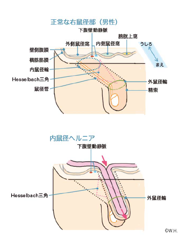 鼠径ヘルニア｜腹部ヘルニア｜四谷メディカルキューブ