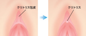 クリトリス包茎とは？悩みを解決する切除手術のメリットやリスクを解説 | コラム一覧｜