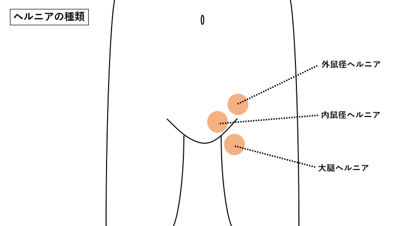 鼠径ヘルニア｜腹部ヘルニア｜四谷メディカルキューブ