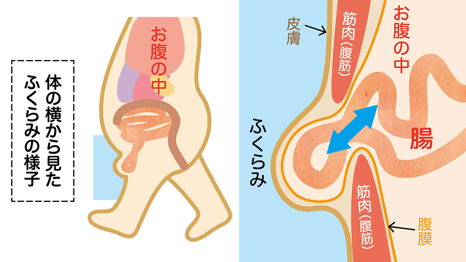 鼠径ヘルニア | 神戸静脈瘤クリニック