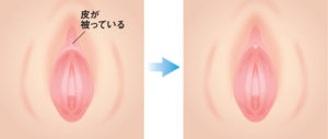 小陰唇が長い・はみ出るのはなぜ？｜原因や対策方法を具体的に解説 | 銀座マイアミ美容外科