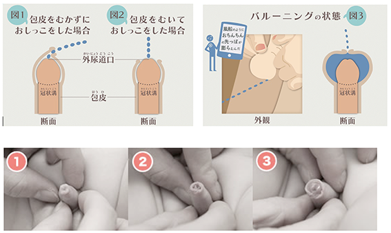 包茎手術 | 種類別の治療法・費用・注意点 | マンモスクリニックグループ