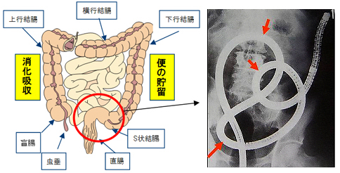 ガモン病院のMtF（腹腔鏡によるS字結腸法）手術 - タイSRS