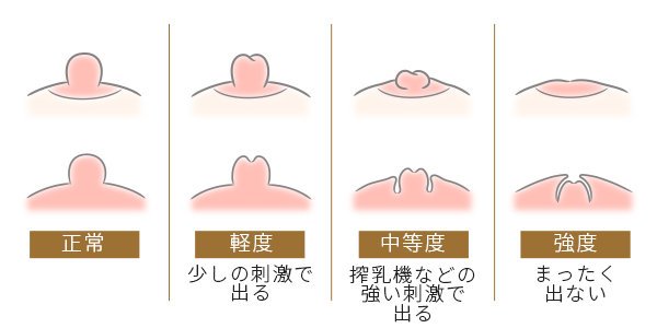 医師監修】～女性化乳房：手術方法～ | 東京美容外科