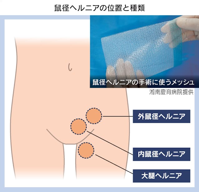 鼠径（そけい）ヘルニア外来 | 医療法人社団