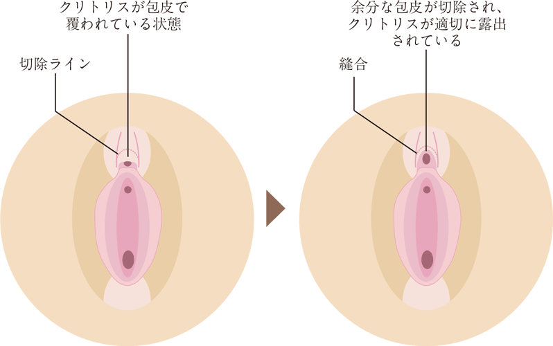 陰核包茎 | eクリニック大阪院【公式】｜美容整形・美容外科