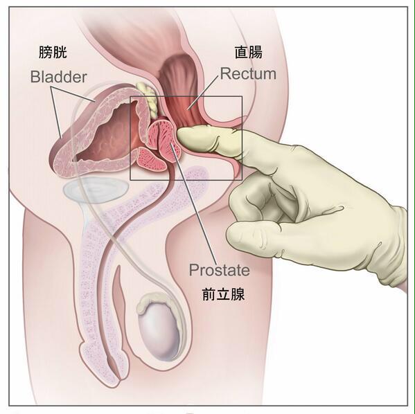 前立腺がんの「高密度焦点式超音波療法（HIFU・ハイフ）」治療の進め方は？治療後の経過は？ – がんプラス