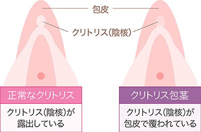 小陰唇が大きい理由について原因と対策を医師が解説【症例写真つき】｜スワンクリニック銀座