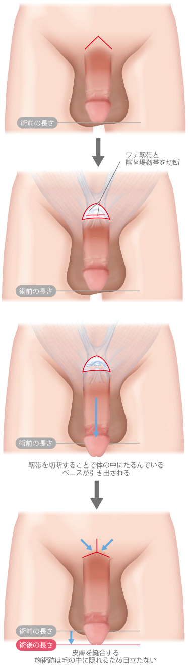 ちんこの形は6種類！女性を1番感じさせられる形とは –メンズクリニック研究会-包茎