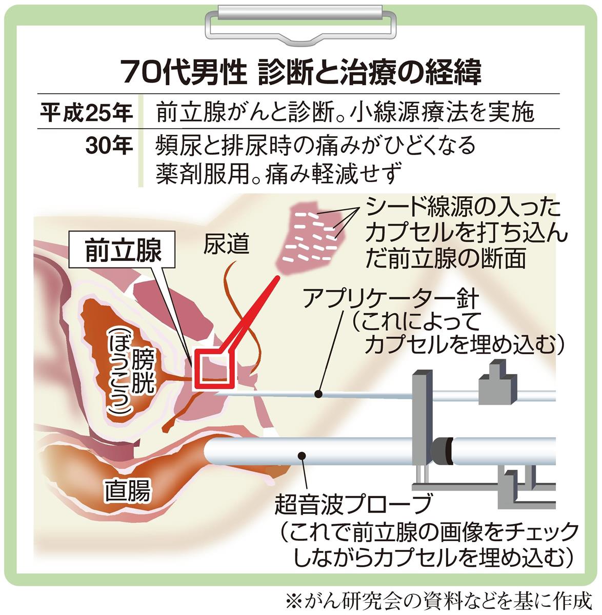 男性の導尿で、カテーテル挿入を約20cmにするのなぜ？｜導尿 | 看護roo![カンゴルー]