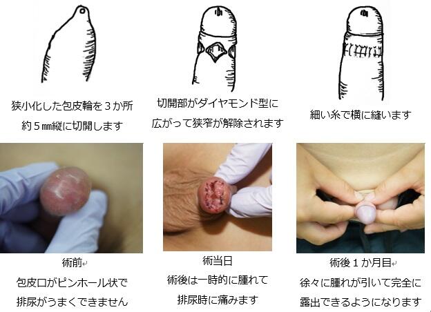 【手術なしの裏技】日本一安全な包茎改善むきむきトレーニング