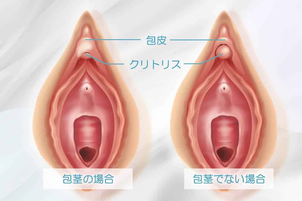 クリトリス包茎 | 婦人科形成なら城本クリニック