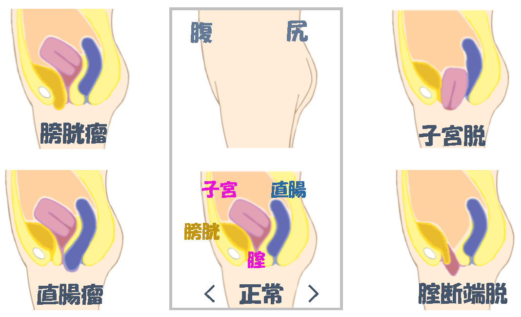 腟に何か挟まっている？尿が出にくい！フェムゾーンの違和感の謎‐ILACY(アイラシイ)働く女性の医療メディア