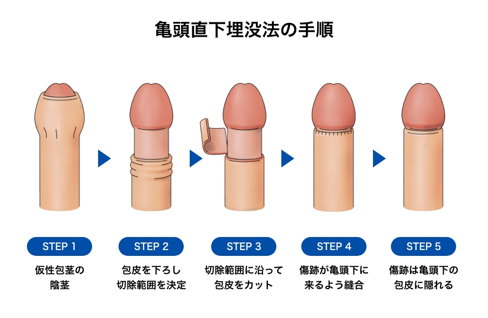 症例17 40代 修正手術＋陰茎増大術 | 山本クリニック｜鳥取県米子市