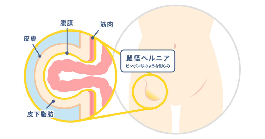 鼠径ヘルニアとは？内鼠径ヘルニア・外鼠径ヘルニアの違いは？