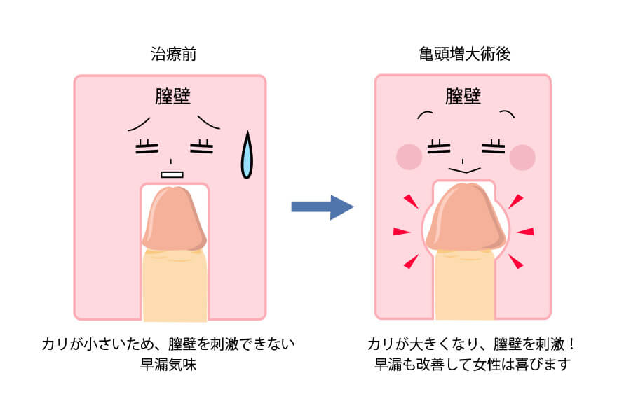 カリ｜大人のおもちゃ用語辞典