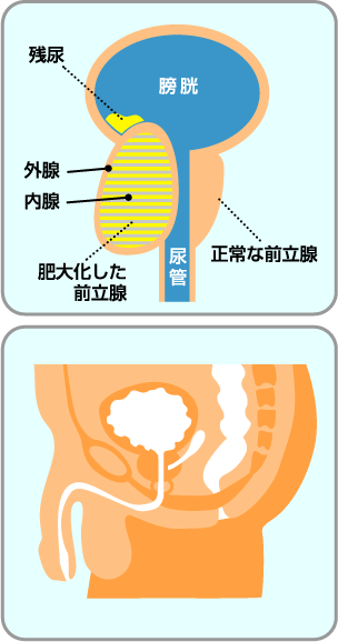 女性ならだれでも罹患の可能性がある「骨盤臓器脱」。どんな病気？ | せいてつLab