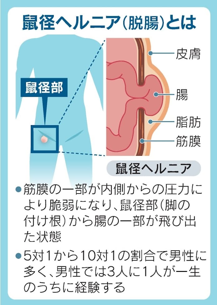 鼠径ヘルニアとは 放置は危険、日帰り手術でも治せる カラダづくり - 日本経済新聞