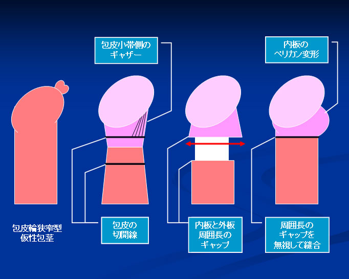 包茎手術の後遺症 「ペリカン変形」: 包茎と包茎手術