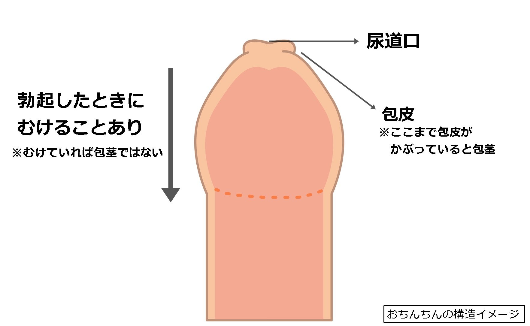 カントン包茎について – メンズ形成外科 | 青山セレス&船橋中央クリニック