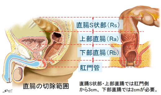 大腸（結腸・直腸）のがん｜横浜労災病院がん情報サイト～がんと向き合うあなたへ～