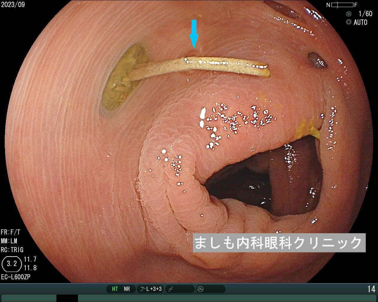 S状結腸憩室症 大腸憩室症の教科書を執筆しました | 世田谷区桜新町の