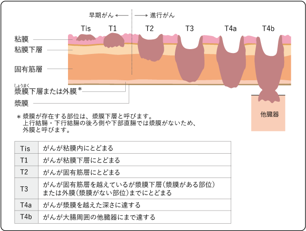 大腸カメラ検査で生じる痛みの特徴や痛みの軽減方法について